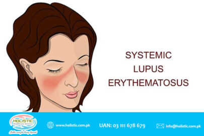 Systemic Lupus